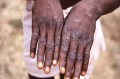 Sah! WHO Resmi Ubah Nama Monkeypox Jadi Mpox