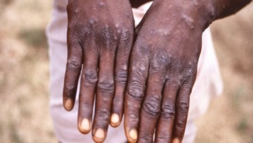 Sah! WHO Resmi Ubah Nama Monkeypox Jadi Mpox