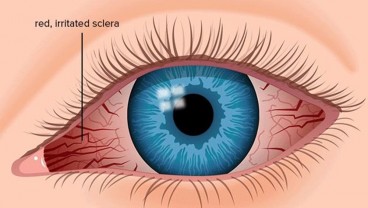 Gejala dan Cara Atasi Computer Vision Syndrome, Akibat Kebanyakan Main Gadget