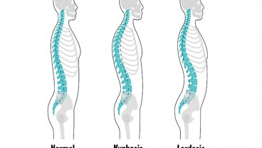 Perbedaan Kifosis dan Lordosis, dan Cara Mencegahnya