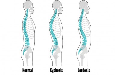 Perbedaan Kifosis dan Lordosis, dan Cara Mencegahnya