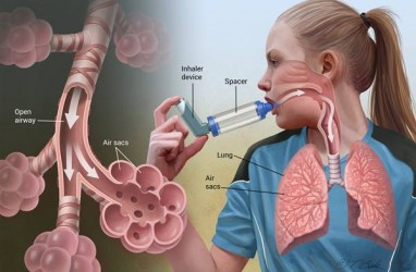 Simak Cara Mencegah dan Mengatasi Penyakit Asma