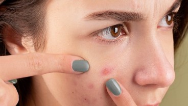 Ini 9 Cara Menghilangkan Jerawat dengan Bahan Alami dan Ampuh