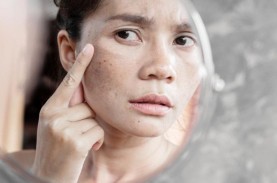 Ini 8 Cara Menghilangkan Flek Hitam di Wajah dengan…