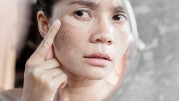 Ini 8 Cara Menghilangkan Flek Hitam di Wajah dengan Bahan Alami