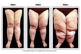 Kenali Lipoedema, Kelebihan Lemak yang Tidak Bisa…