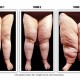 Kenali Lipoedema, Kelebihan Lemak yang Tidak Bisa Hilang dengan Diet dan Olahraga