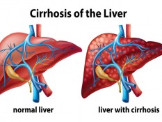 Kenali Gejala dan Tanda Penyakit Liver dari Kaki