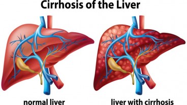 Kenali Gejala dan Tanda Penyakit Liver dari Kaki