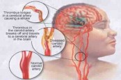 Ciri-ciri Sakit Kepala Tanda Stroke