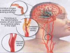Ciri-ciri Sakit Kepala Tanda Stroke