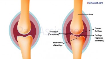 Ciri-ciri Osteoarthritisdi Tangan dan Jari Anda