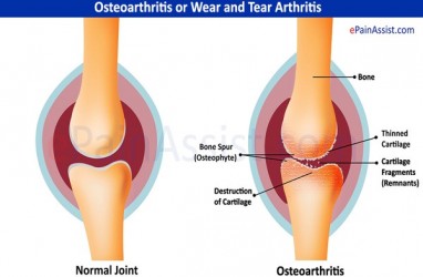 Ciri-ciri Osteoarthritisdi Tangan dan Jari Anda