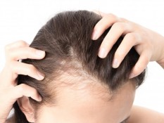 Berminat Transplantasi Rambut? Segini Perkiraan Biayanya