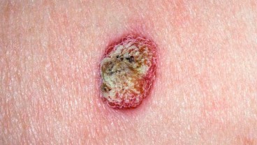 Melanoma, Kanker Kulit yang Paling Berbahaya