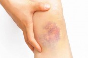 Sering Mengalami Memar di Tubuh? Mungkin Ini Penyebabnya