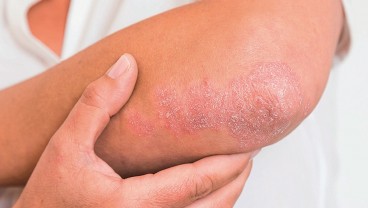 Tips Kelola Peradangan Kronis Karena Psoriasis