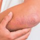 Tips Kelola Peradangan Kronis Karena Psoriasis