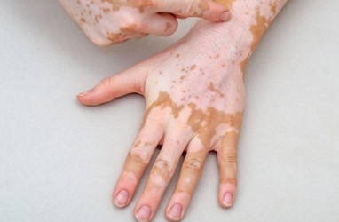 Penyebab Vitiligo, Bercak-bercak Putih di Tubuh dan Cara Pencegahannya