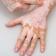 Penyebab Vitiligo, Bercak-bercak Putih di Tubuh dan Cara Pencegahannya