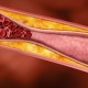 Olahraga Intens Bisa Tingkatkan Risiko Stroke bagi yang Memiliki Arteri Tersumbat