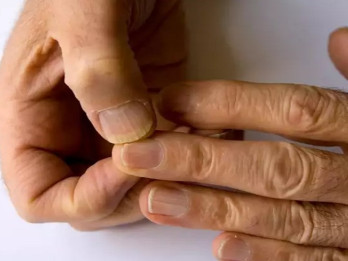 Kuku Anda Rapuh dan Mudah Patah? Mungkin Kekurangan Vitamin Berikut Ini