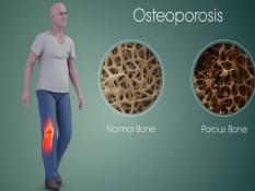 Ini Lho Penyebab Utama Osteoporosis pada Perempuan