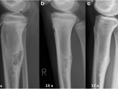 Gejala Osteosarcoma dan Sarkoma Ewing, Tumor Ganas pada Tulang