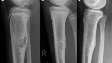 Gejala Osteosarcoma dan Sarkoma Ewing, Tumor Ganas pada Tulang