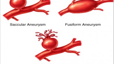 Bisa Mematikan, Kenali Aneurisma, Tonjolan di dalam Arteri