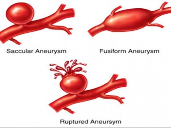 Bisa Mematikan, Kenali Aneurisma, Tonjolan di dalam Arteri