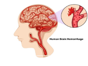 Penyebab dan Gejala Pendarahan Otak, Seperti yang Dialami Cak Nun
