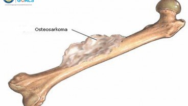 Kenali Fakta-fakta Tumor Tulang, Osteosarkoma, Sering Menyerang Anak-anak