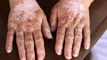 Viral Kena Vitiligo Karena Minum Suplemen, Bagaimana Faktanya?