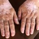 Viral Kena Vitiligo Karena Minum Suplemen, Bagaimana Faktanya?