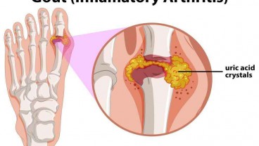 Obat Asam Urat Alami yang Ampuh dan Mudah Ditemukan