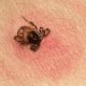 Gejala dan Penyebab Lyme Disease yang Dialami Bella Hadid