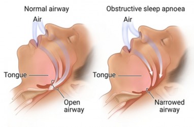 Penyebab-Penyebab Utama Seseorang Meninggal dalam Tidurnya