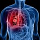 Penelitian: 1 dari 10 Kasus Kanker Paru Akibat Polusi Udara