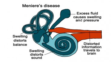 Kenali Apa Itu Penyakit Meniere, yang Bisa Bikin Penderitanya Mendadak Pingsan