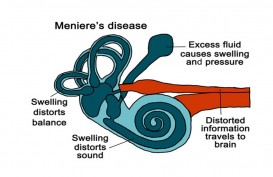 Kenali Apa Itu Penyakit Meniere, yang Bisa Bikin Penderitanya Mendadak Pingsan