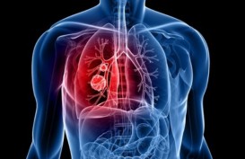 5 Penyebab Kanker Paru pada Non Perokok, Salah Satunya Polusi Udara