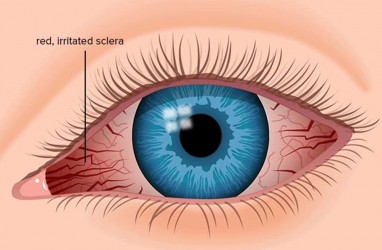 Kenali Gejala Penyakit dari Kondisi Mata Anda