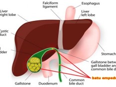 Kenali Perbedaan Batu Empedu dan Batu Ginjal