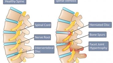 Gejala dan Penyebab Spinal Stenosis, Salah Satunya Bisa Karena Tumor