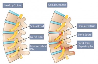 Gejala dan Penyebab Spinal Stenosis, Salah Satunya Bisa Karena Tumor