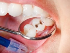 Tips Mencegah Gigi Berlubang, Mudah dan Efektif