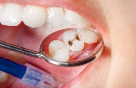Tips Mencegah Gigi Berlubang, Mudah dan Efektif