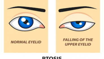 Fakta-fakta Ptosis, Kelainan pada Kelopak Mata dan Penyebabnya