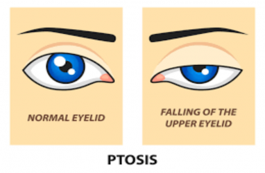 Fakta-fakta Ptosis, Kelainan pada Kelopak Mata dan Penyebabnya